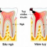 4 giai đoạn của quá trình sâu răng