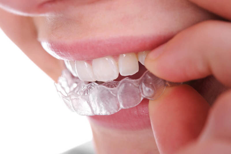 Niềng răng trong suốt siêu tiện lợi Invisalign