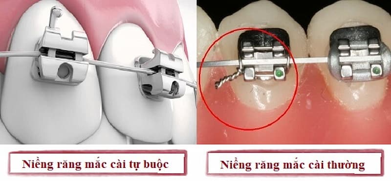 Niềng răng mắc cài tự đóng hay mắc cài thường là phân vân của nhiều người trước khi niềng