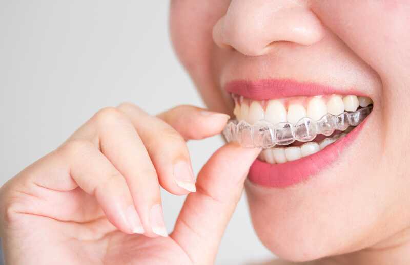 Kỹ thuật niềng không mắc cài invisalign của Mỹ mang lại nhiều ưu điểm nổi bật