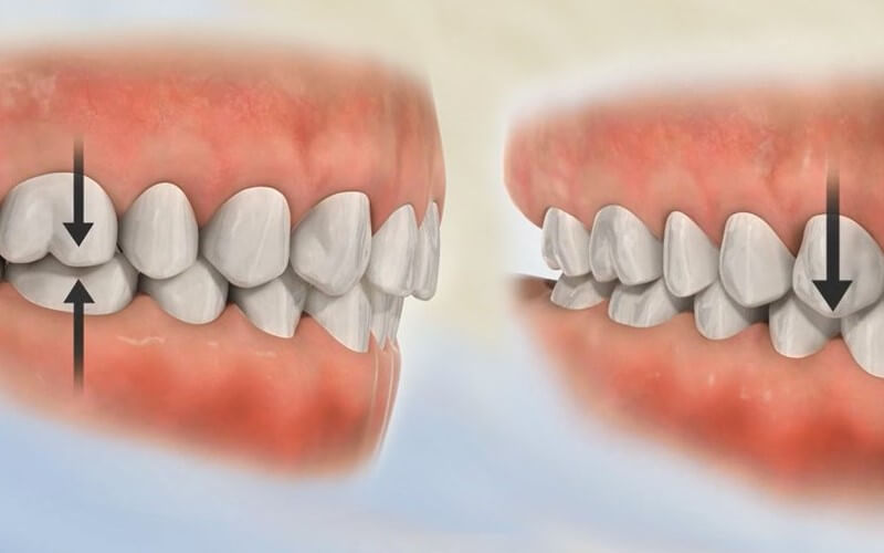 Khớp cắn sâu là vấn đề thường gặp của nhiều người bệnh