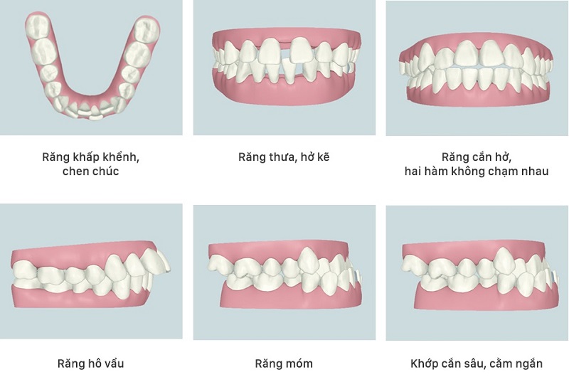 Các dạng sai lệch khớp cắn điển hình