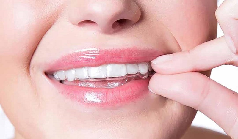 Niềng khay Invisalign mang lại hiệu quả thẩm mỹ ấn tượng