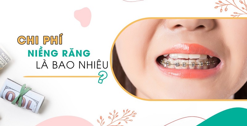 Niềng răng lệch khớp cắn bao nhiêu tiền là thắc mắc của nhiều người