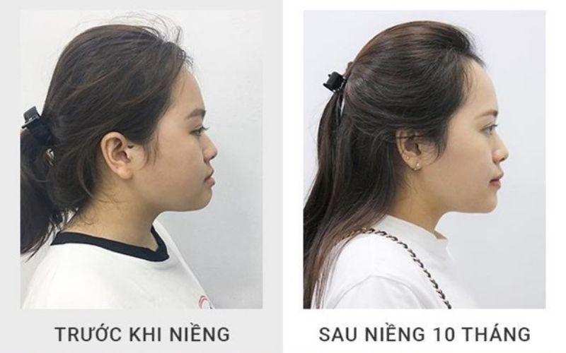 Niềng răng trước và sau giúp thay đổi góc nghiêng