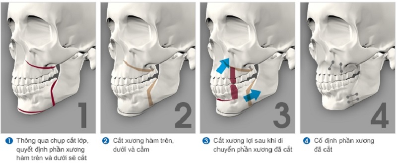 Phẫu thuật cắt xương hàm dưới do thay đổi cấu trúc xương hàm