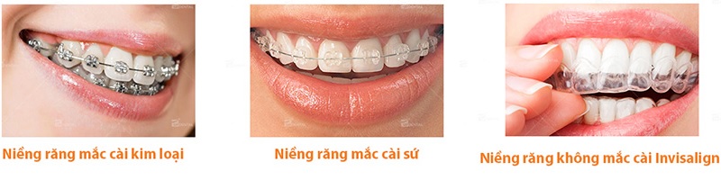 Một số phương pháp niềng răng thường được chọn