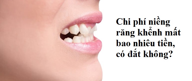 Chi phí niềng răng khểnh mất bao nhiêu tiền, có đắt không?