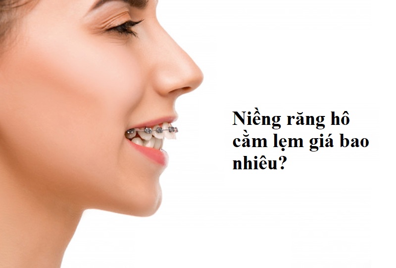 Niềng răng hô cằm lẹm giá bao nhiêu?