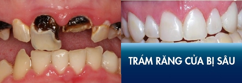 Trám răng mang lại hiệu quả về thẩm mỹ cao nhất cho răng sâu