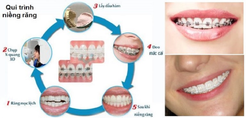 Quy trình mô phỏng quá trình thực hiện niềng cửa răng hô