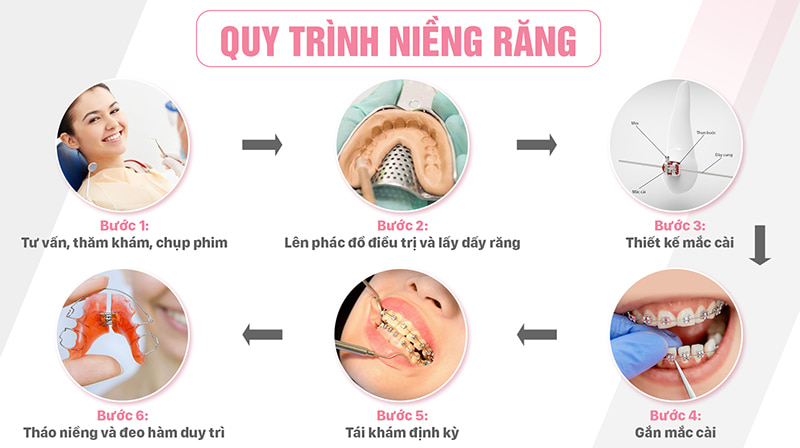 Quy trình thực hiện niềng răng