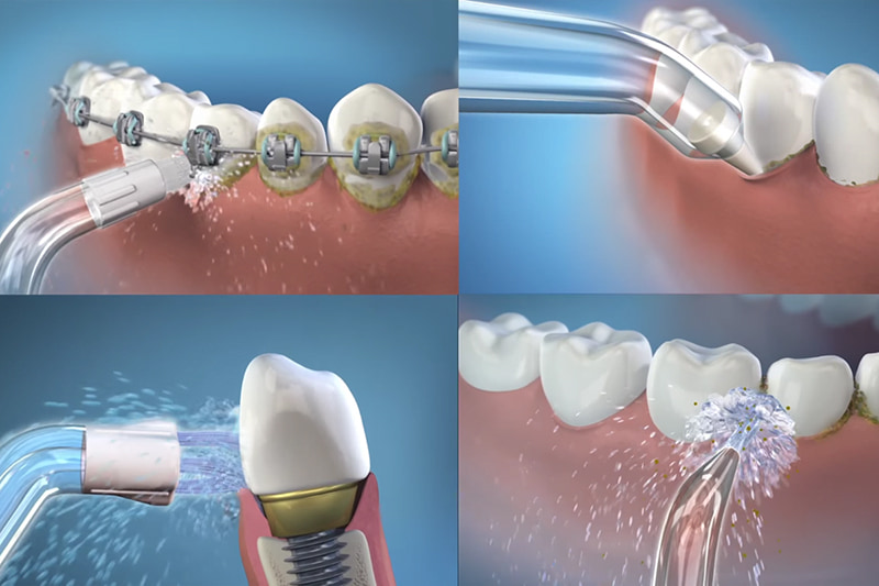 Có thể sử dụng tăm nước để vệ sinh kẽ răng trong quá trình niềng