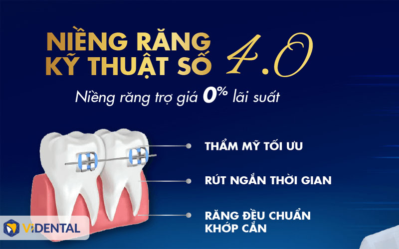 Niềng răng kỹ thuật số tại ViDental trả góp 0% , rút ngắn thời gian điều trị