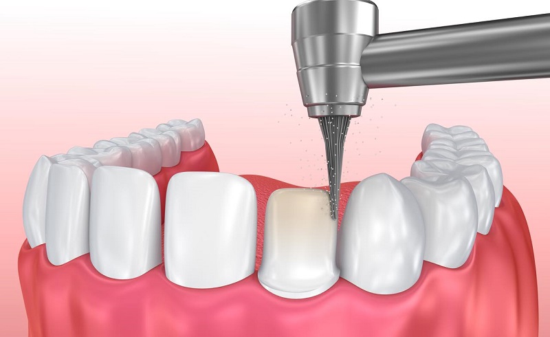 Thực hiện mài cùi răng để làm trụ bọc răng sứ bên ngoài