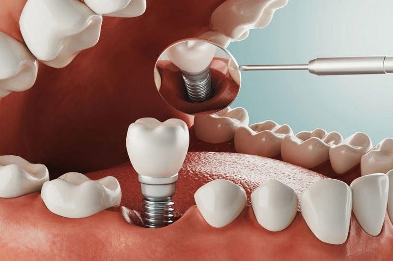 Cấy ghép implant sở hữu nhiều ưu điểm vượt trội