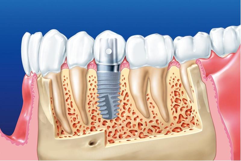 Việc đặt trụ titan implant sẽ được thực hiện trong phòng vô trùng của trung tâm nha khoa