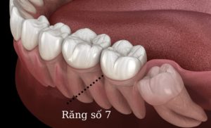 Bọc Răng Số 7 Có Nên Không? Chi Phí Khi Tiến Hành Bọc Răng Hàm