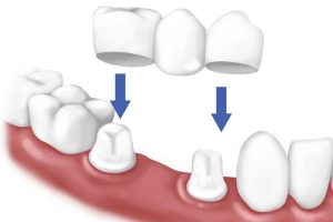 Cầu Răng Sứ Là Gì? Quy Trình Thực Hiện Và Những Lưu Ý Bạn Nên Biết