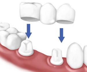 Cầu Răng Sứ Là Gì? Quy Trình Thực Hiện Và Những Lưu Ý Bạn Nên Biết