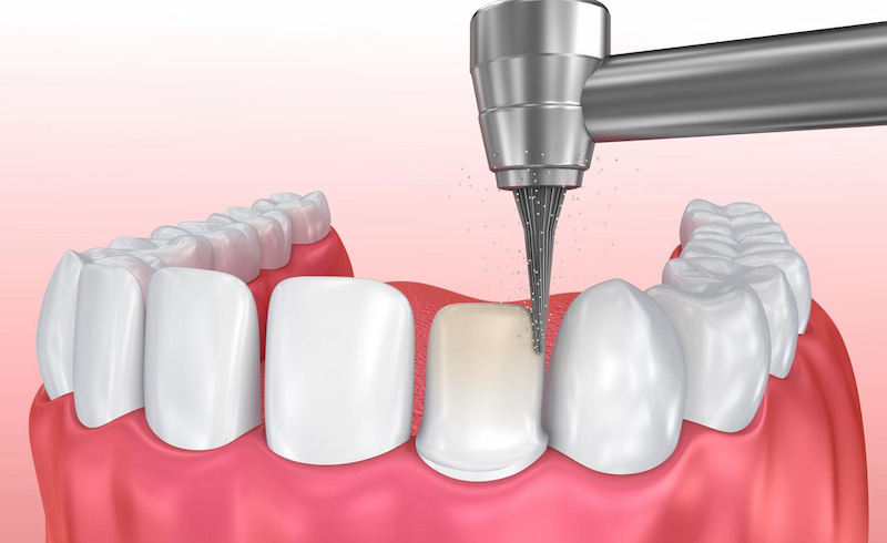 Mài răng yêu cầu cao về kỹ thuật thực hiện