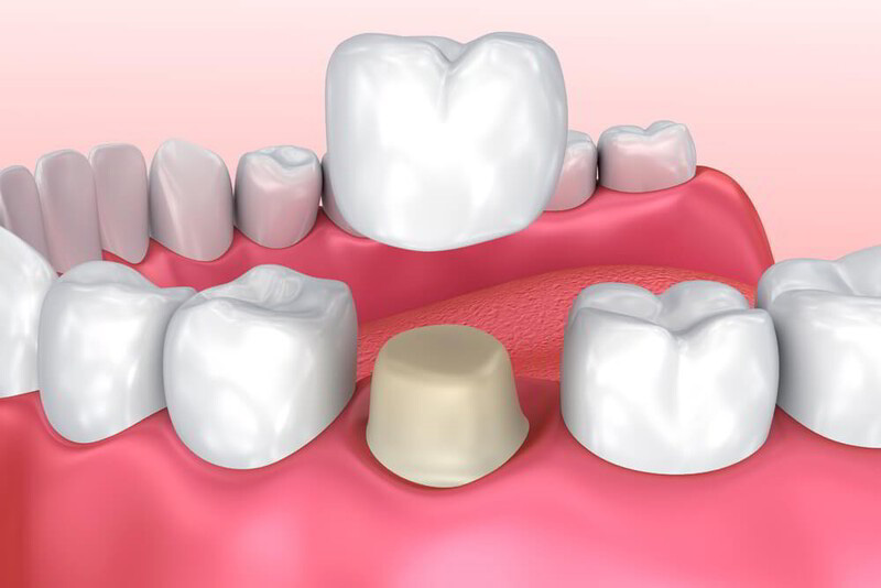 Mão răng sứ là một dạng răng giả có màu sắc, hình dạng giống như răng thật