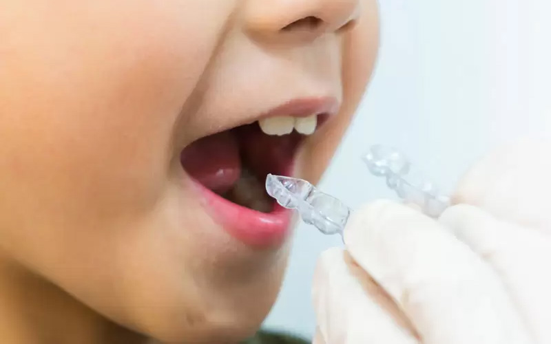 Niềng răng trong suốt bằng khay invisalign