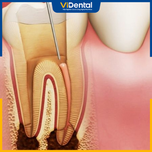 Mủ và tủy chết sẽ được lấy khỏi chân răng