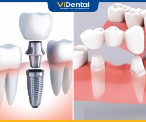 Trồng Răng Giả Cố Định: Phương Pháp, Giá Thành Và Lưu Ý