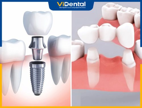 Trồng Răng Giả Cố Định: Phương Pháp, Giá Thành Và Lưu Ý