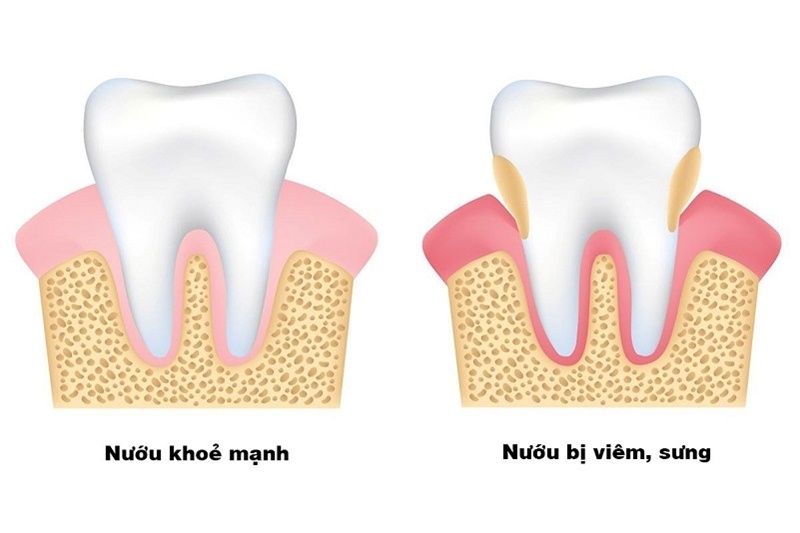 Bé 3 tuổi bị sưng nướu răng là bệnh nha khoa phổ biến 