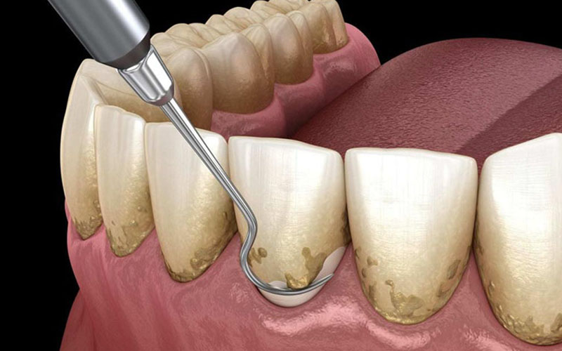 Các đốm đen xuất hiện là dấu hiệu cảnh báo răng của bạn đang bị sâu