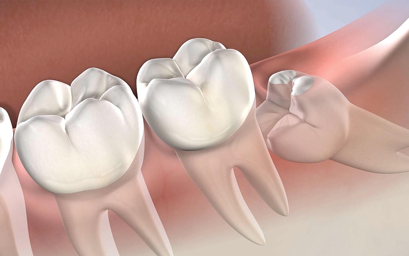 Răng khôn mọc lệch, mọc gầm có thể gây ra nhiều biến chứng nguy hiểm