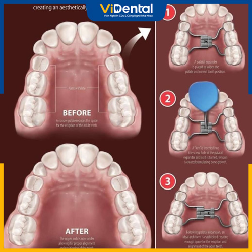 Nong hàm giúp cải thiện cung hàm hẹp, răng không đủ vị trí mọc