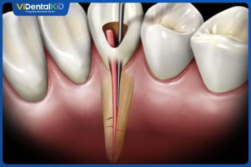 Viêm Tủy Răng Nguy Hiểm Không? Nguyên Nhân Và Cách Xử Lý