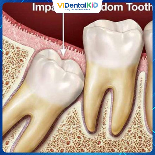 Răng số 8 không có tác dụng thẩm mỹ hay chức năng nhai