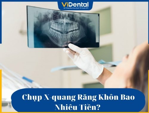 Chụp X-quang răng khôn bao nhiêu tiền