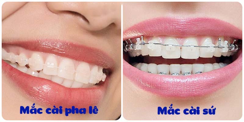 So sánh mắc cài pha lê và mắc cài sứ