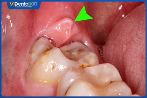 Áp Xe Răng Khôn Nguy Hiểm Không? Nguyên Nhân, Cách Xử Lý