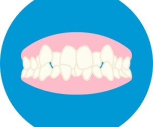 gia-nieng-rang-invisalign-1