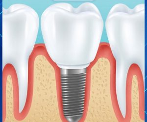 Phục hình răng Implant là phương pháp hiện đại nhất hiện nay