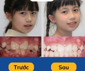 khach-hang-nieng-invisalign