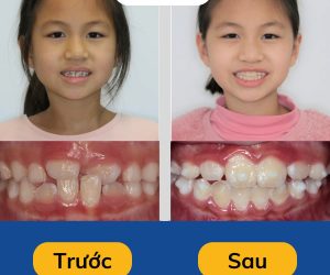 khach-hang-nieng-rang-invisalign