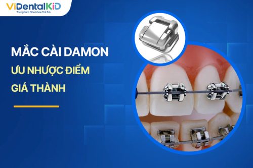 Mắc Cài Damon Là Gì? Ưu Nhược Điểm Và Chi Phí Cụ Thể