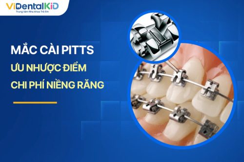 Mắc Cài Pitts Là Gì? Ưu Nhược Điểm, Chi Phí Niềng Răng