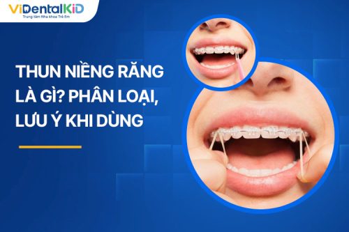 Thun Niềng Răng Là Gì? Phân Loại Và Lưu Ý Khi Sử Dụng