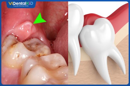 Viêm Lợi Trùm Răng Khôn Do Đâu? Cách Điều Trị Và Phòng Ngừa