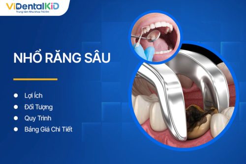 Nhổ Răng Sâu: Lợi Ích, Đối Tượng, Quy Trình Và Bảng Giá