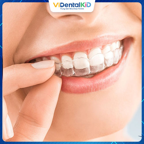 Niềng răng Invisalign vô cùng tiện lợi, đảm bảo thẩm mỹ