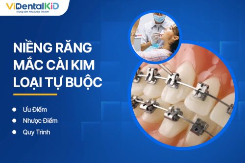 Niềng Răng Mắc Cài Kim Loại Tự Buộc Là Gì? Ưu Nhược Điểm